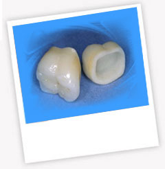Impianto dentale